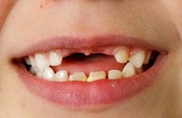 تقنية جديدة لعلماء بريطانيين لعلاج الأسنان بلا ألم
